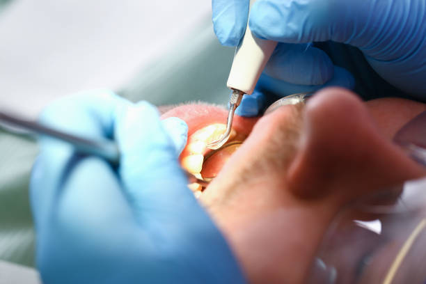 Best Emergency Dental Care for Broken or Chipped Teeth in Mount Sinai, NY