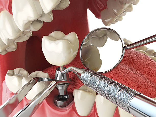 Best Emergency Tooth Extraction in Mount Sinai, NY